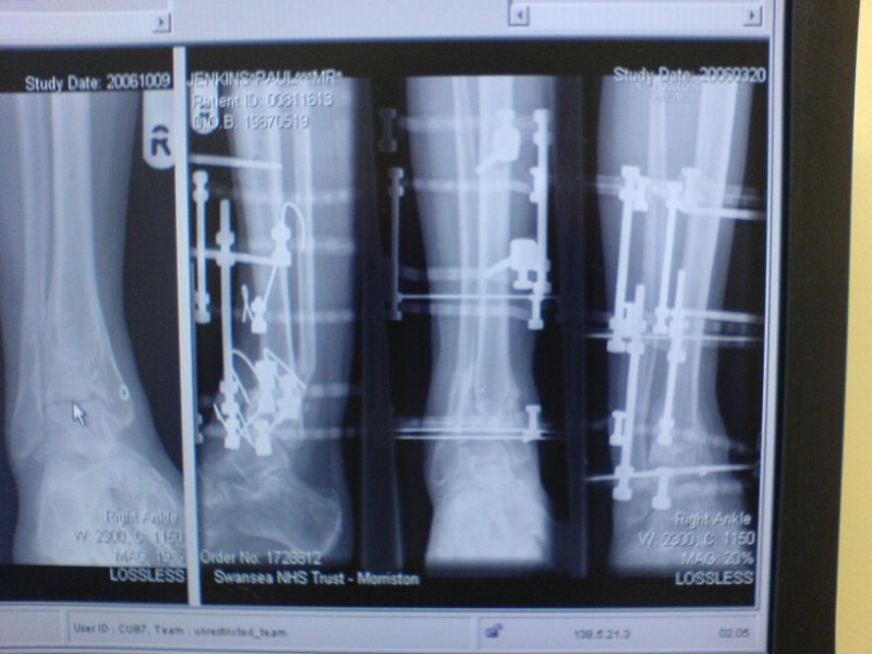 broken leg 2.JPG