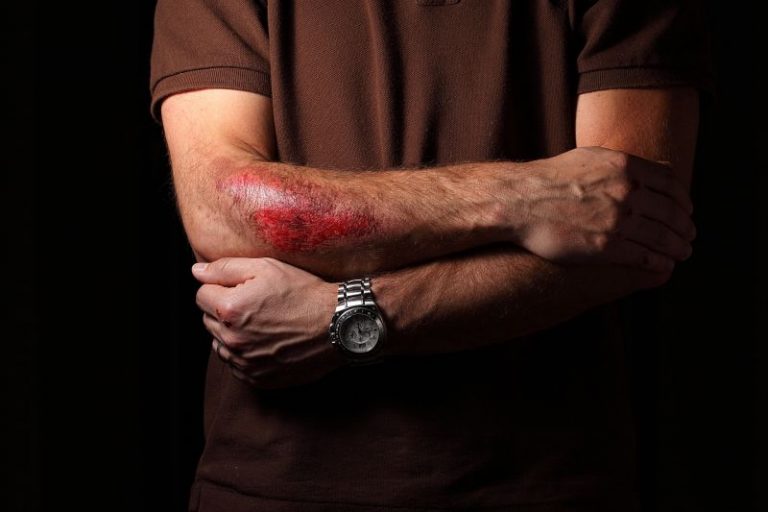 How To Treat Road Rash After A Motorcycle Accident