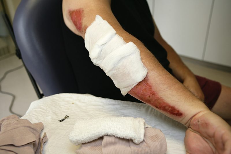 Road rash motorcycle accident